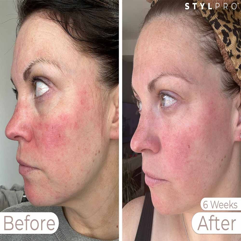 StylPro Wavelength LED Face Mask